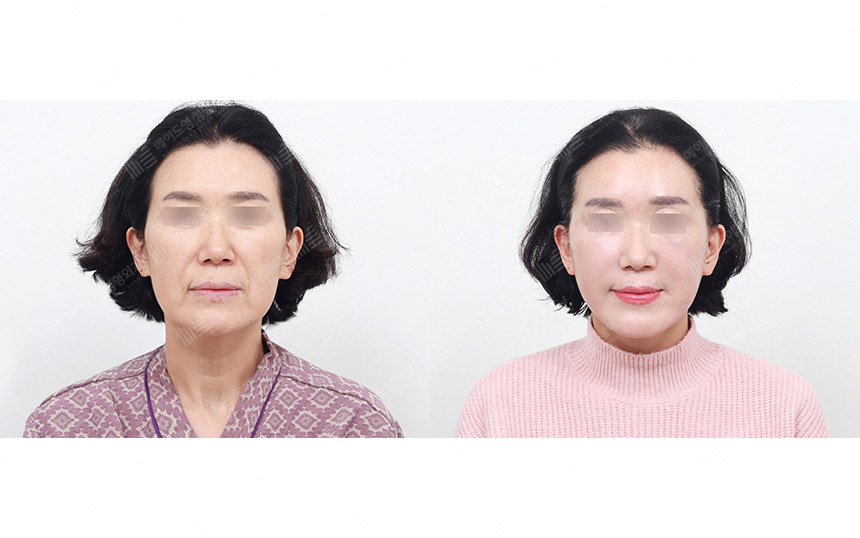 face lifting korea before after pictures - Lifting Before and After