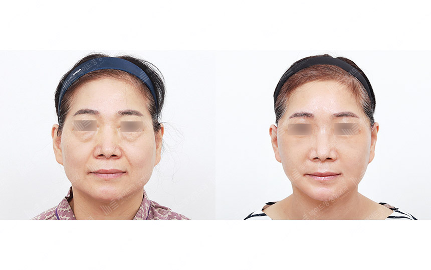 face lifting korea before after pictures - Lifting Before and After