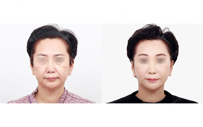 face lifting korea before after pictures - Lifting Before and After