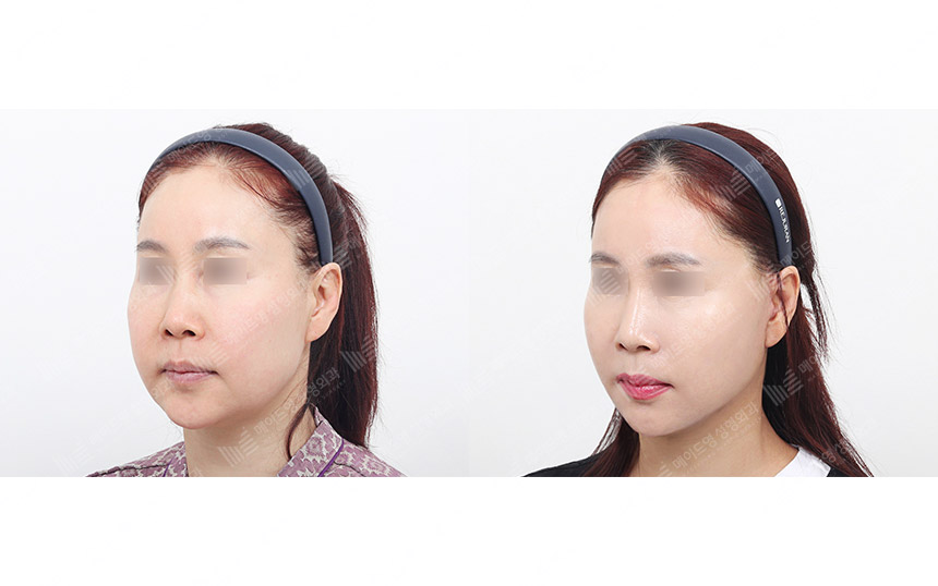 face lifting korea before after pictures - Lifting Before and After