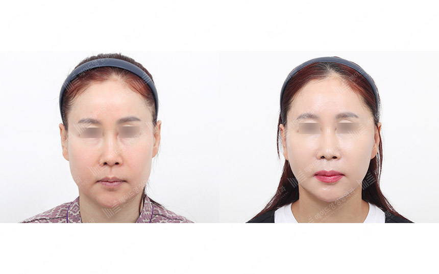 face lifting korea before after pictures - Lifting Before and After