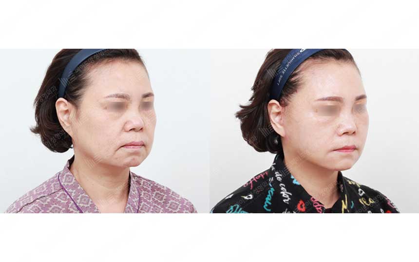 face lifting korea before after pictures - Lifting Before and After