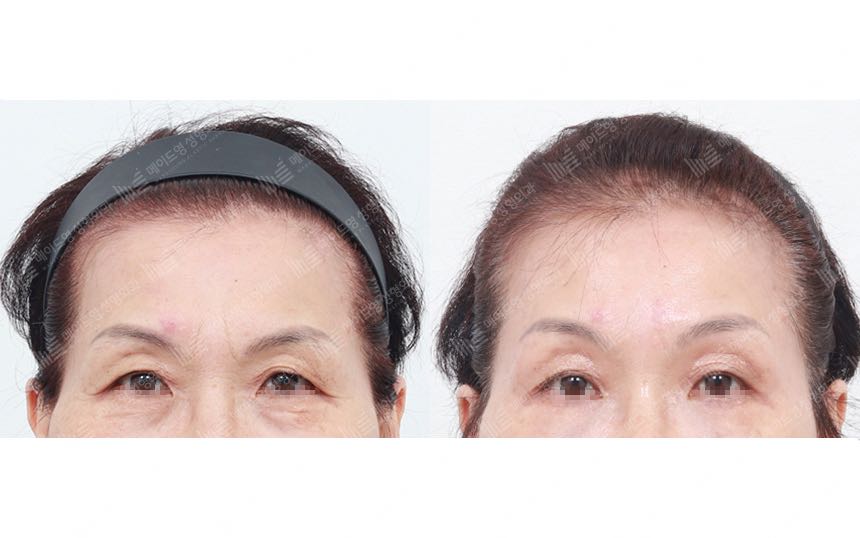 face lifting korea before after pictures - Lifting Before and After