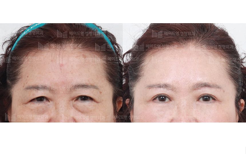 face lifting korea before after pictures - Lifting Before and After