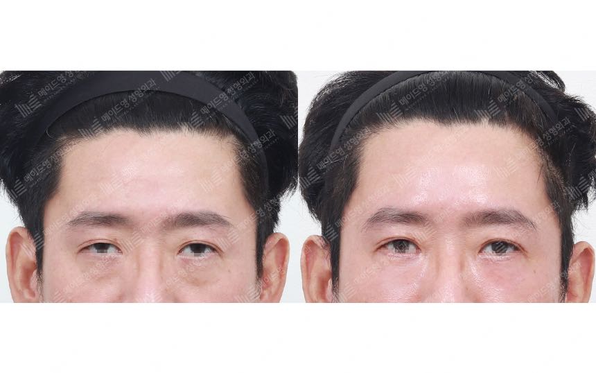 face lifting korea before after pictures - Lifting Before and After