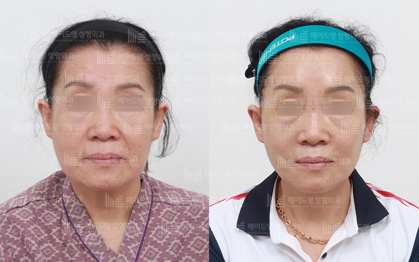 face lifting korea before after pictures - Lifting Before and After