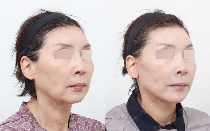 face lifting korea before after pictures - Lifting Before and After