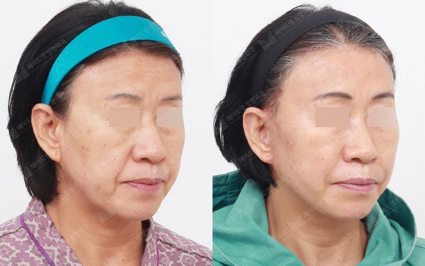 face lifting korea before after pictures - Lifting Before and After