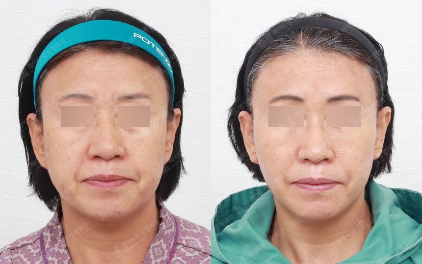 face lifting korea before after pictures - Lifting Before and After