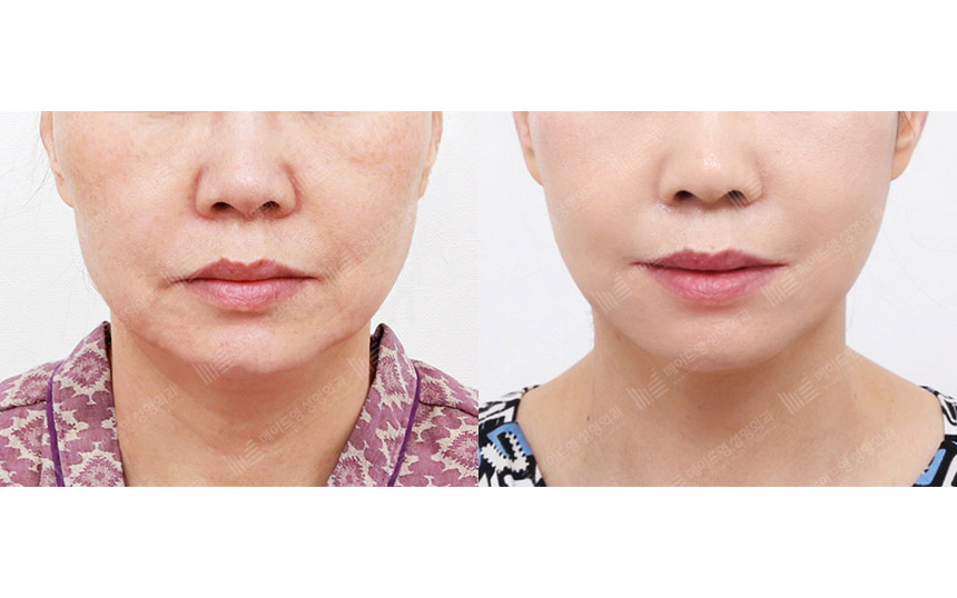 face lifting korea before after pictures - Lifting Before and After