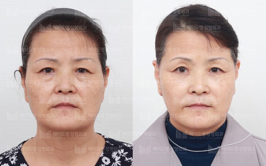 face lifting korea before after pictures - Lifting Before and After