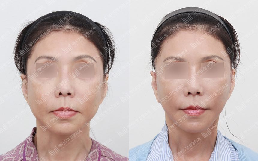 face lifting korea before after pictures - Lifting Before and After