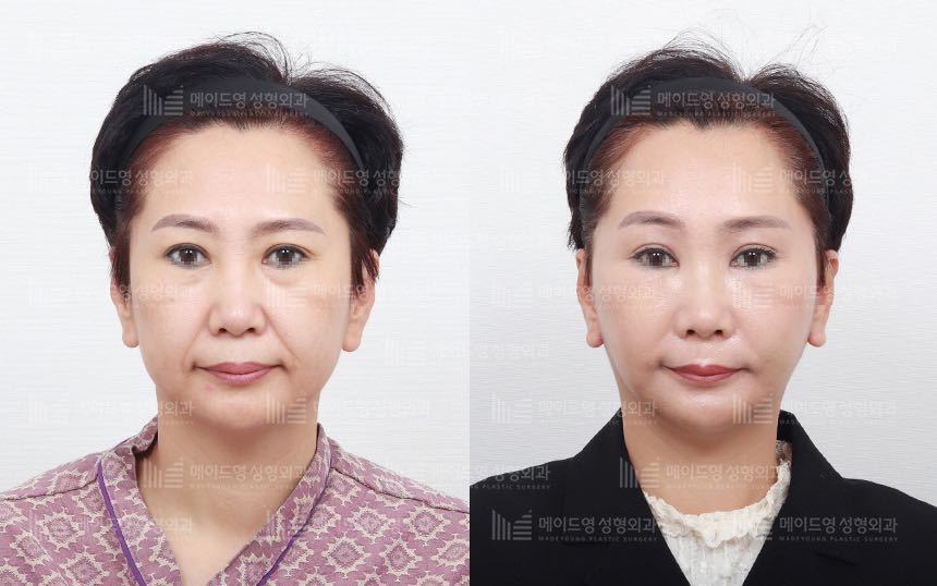 face lifting korea before after pictures - Lifting Before and After