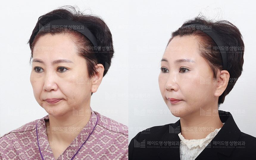 face lifting korea before after pictures - Lifting Before and After