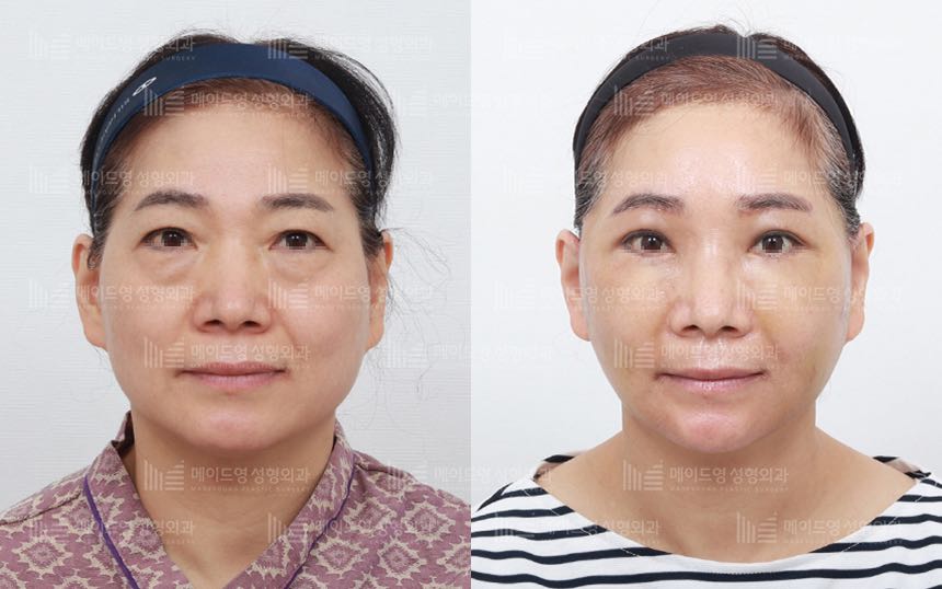 face lifting korea before after pictures - Lifting Before and After