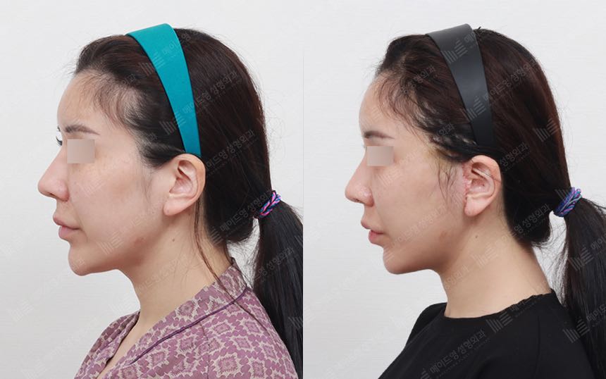 face lifting korea before after pictures - Lifting Before and After
