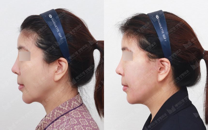 face lifting korea before after pictures - Lifting Before and After