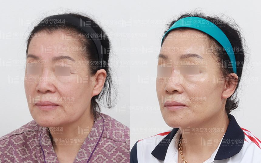 face lifting korea before after pictures - Lifting Before and After