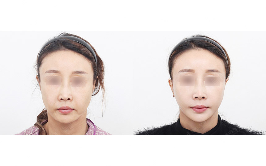 face lifting korea before after pictures - Lifting Before and After