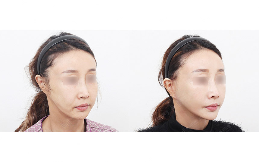 face lifting korea before after pictures - Lifting Before and After