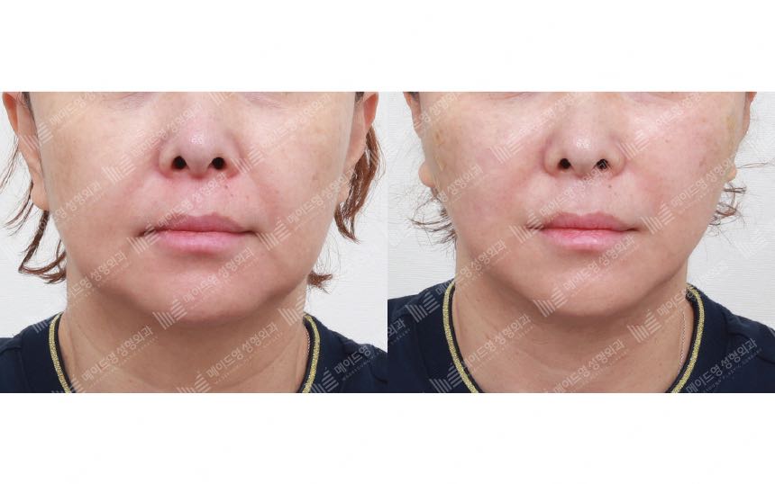 face lifting korea before after pictures - Lifting Before and After