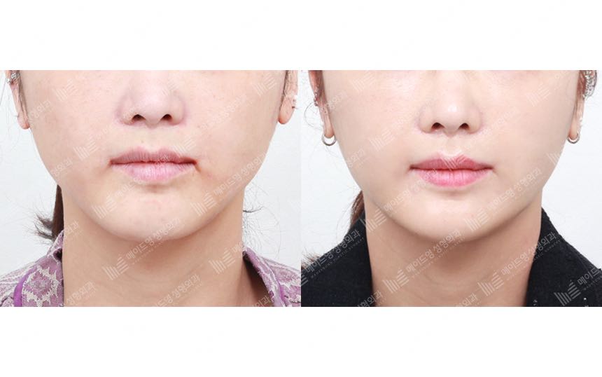 face lifting korea before after pictures - Lifting Before and After