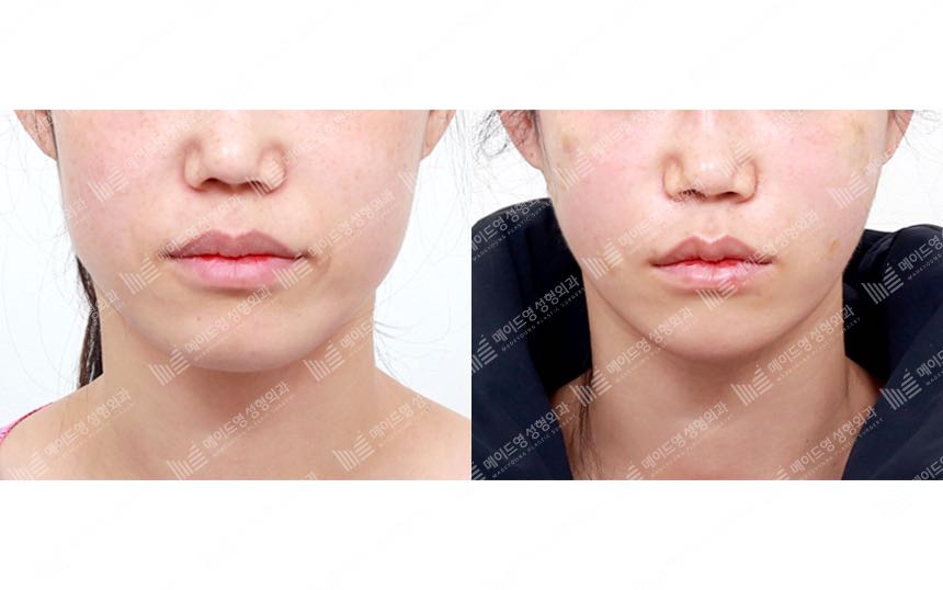 face lifting korea before after pictures - Lifting Before and After