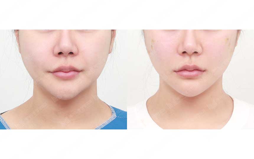 face lifting korea before after pictures - Lifting Before and After