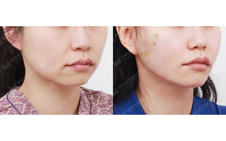 face lifting korea before after pictures - Lifting Before and After