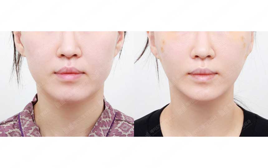 face lifting korea before after pictures - Lifting Before and After