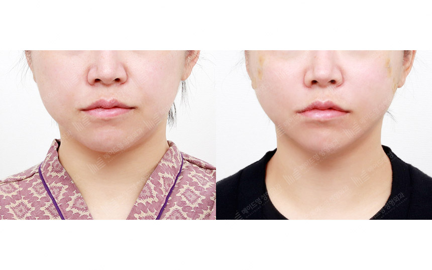 face lifting korea before after pictures - Lifting Before and After