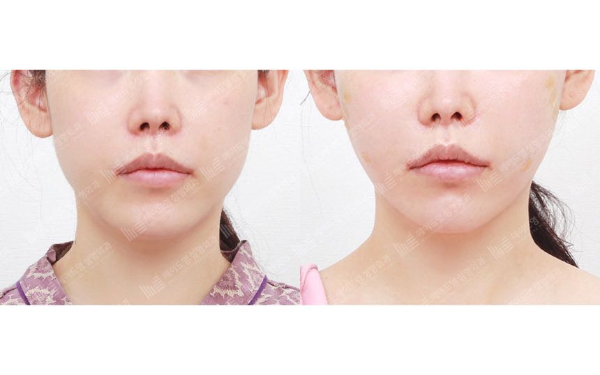 face lifting korea before after pictures - Lifting Before and After