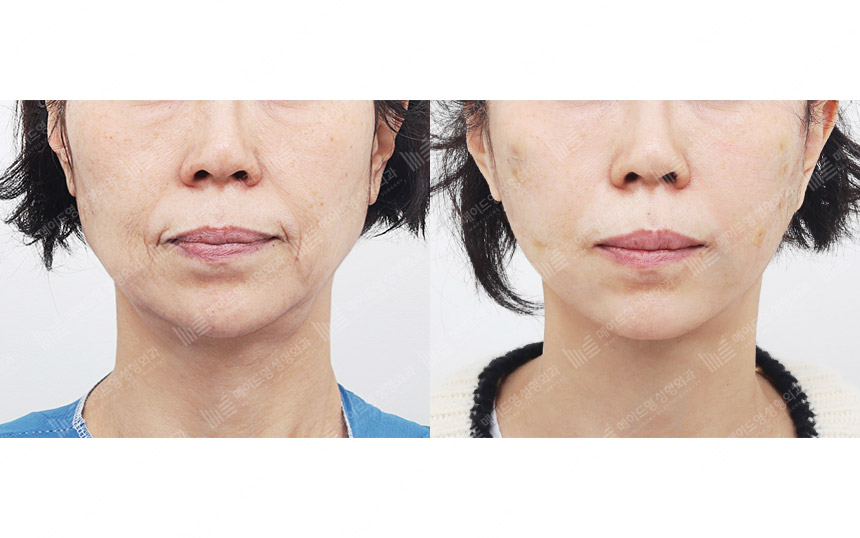 face lifting korea before after pictures - Lifting Before and After