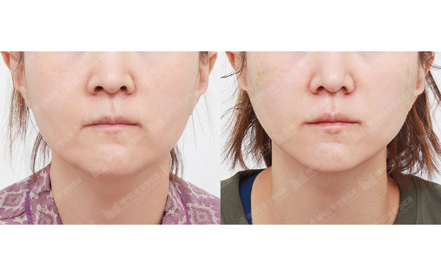 face lifting korea before after pictures - Lifting Before and After