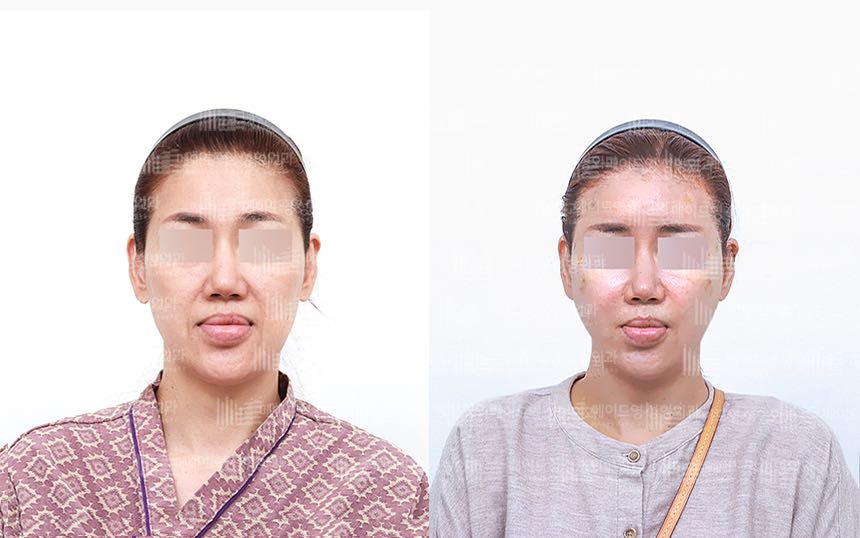 face lifting korea before after pictures - Lifting Before and After