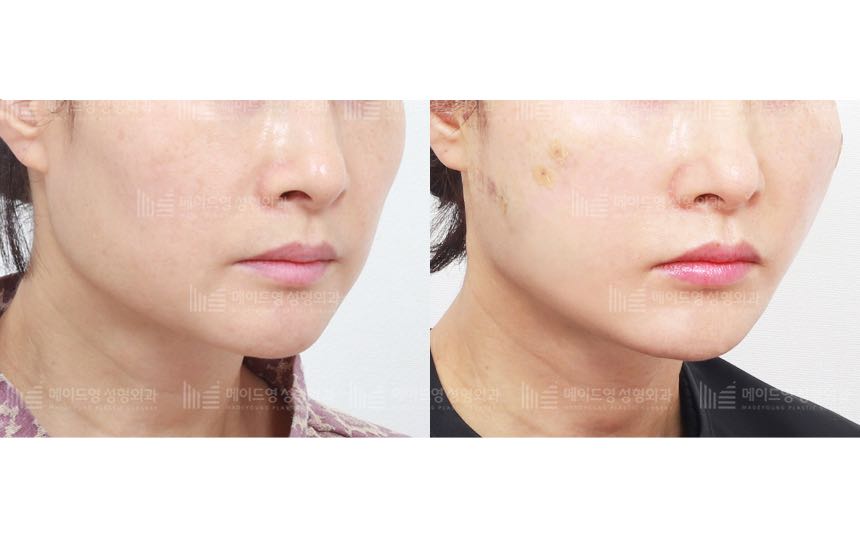 face lifting korea before after pictures - Lifting Before and After