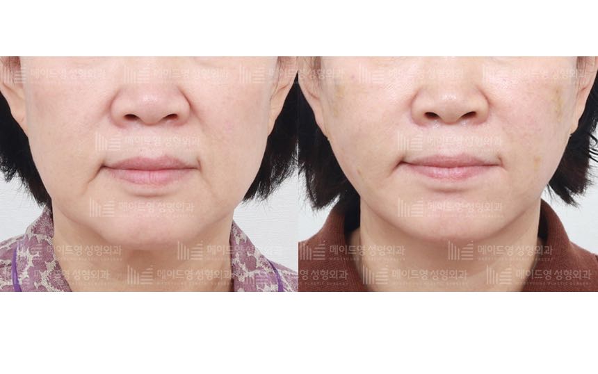 face lifting korea before after pictures - Lifting Before and After
