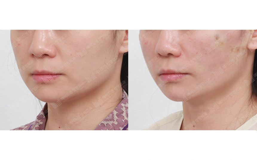 face lifting korea before after pictures - Lifting Before and After