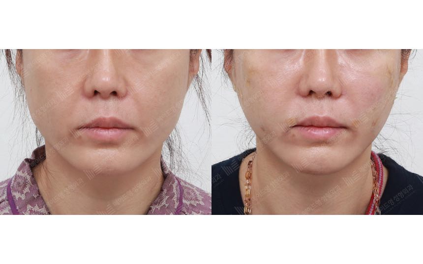 face lifting korea before after pictures - Lifting Before and After