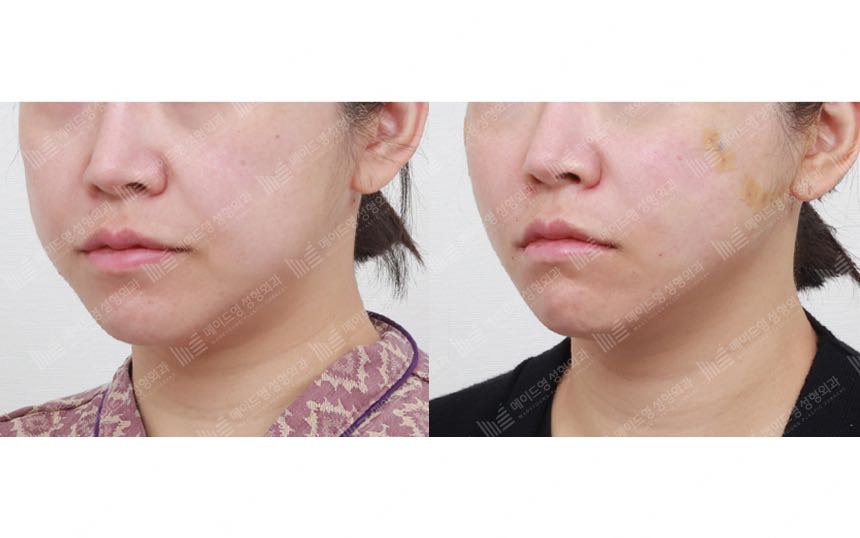 face lifting korea before after pictures - Lifting Before and After