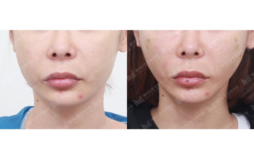 face lifting korea before after pictures - Lifting Before and After