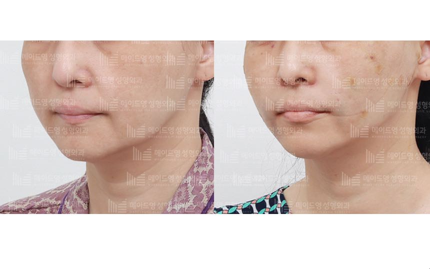 face lifting korea before after pictures - Lifting Before and After