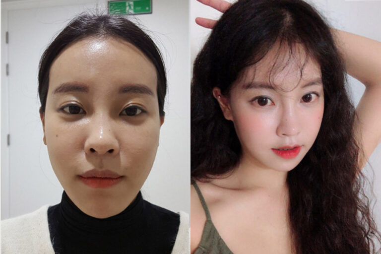 Dual-Osteotomy Chin Reduction and Revision Eye Surgery: My Recovery Story