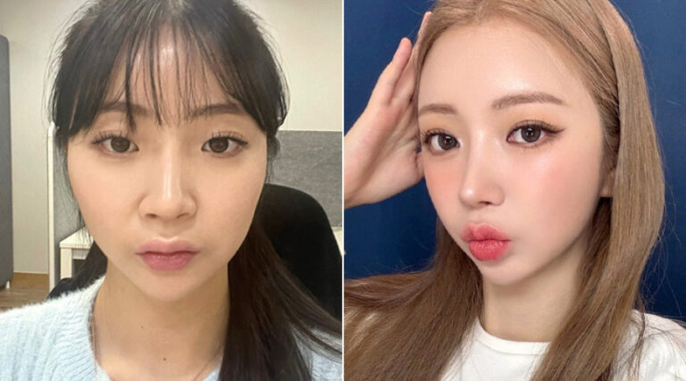 My 150-Day Facial Contouring and Revision Rhinoplasty Journey