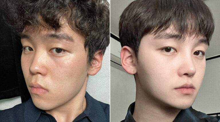 My Rhinoplasty and Metal-Free Chin Surgery In Korea Photo Diary