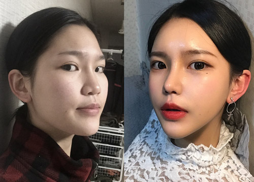 My Facial Contouring and Rhinoplasty Before and After in Korea