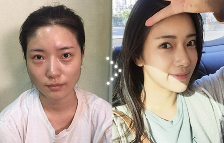 My Square-Jaw Reduction Journey In Korea: From Day 1 to Month 8
