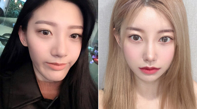 Zygoma Reduction, Revision Rhinoplasty, and Genioplasty: A 90-Day Journey